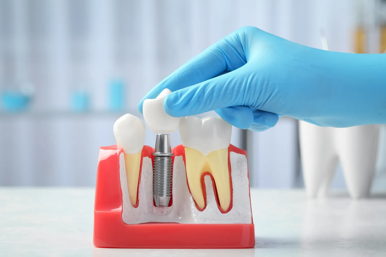 Rodzaje implantów zębowych