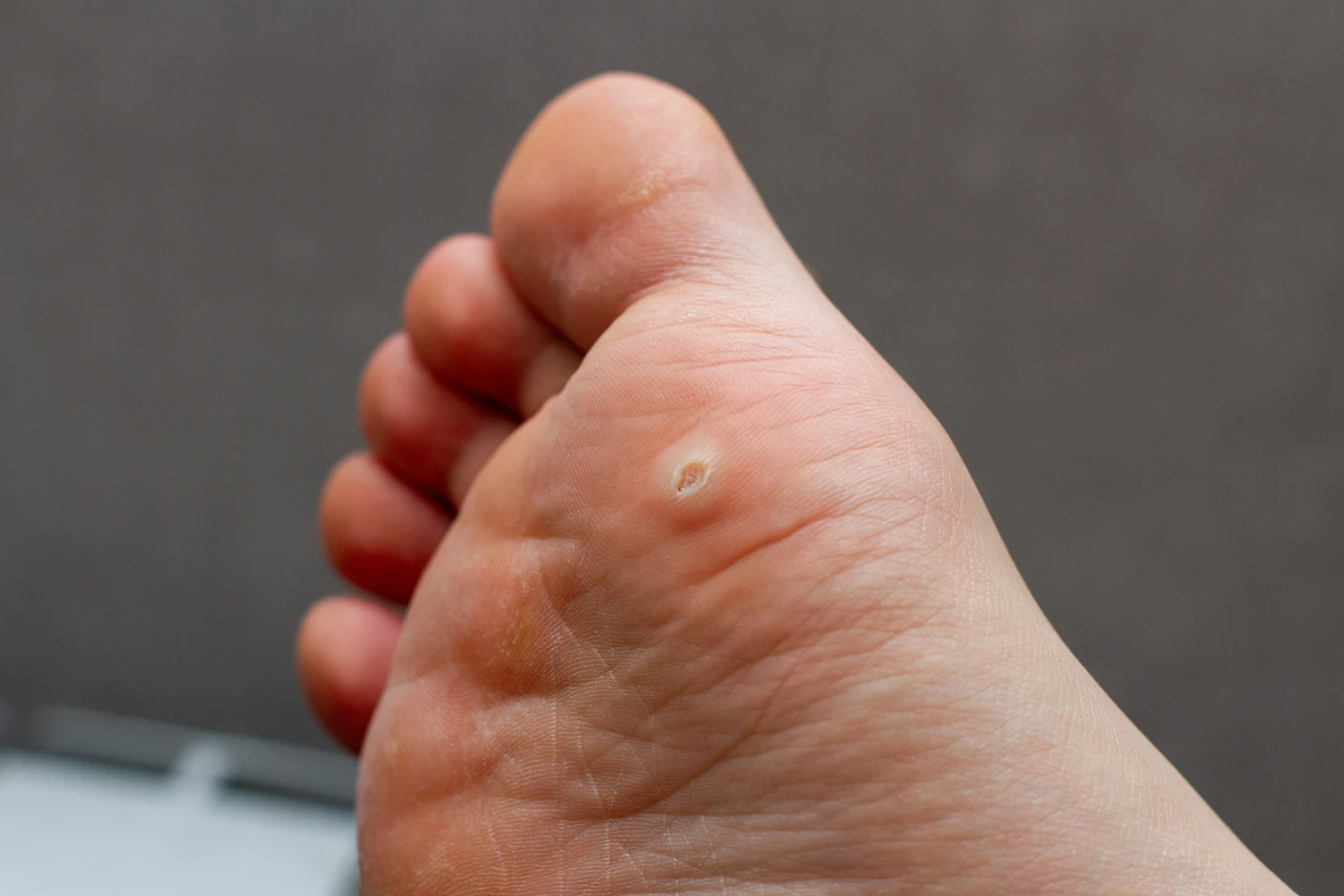 Czym jest pedicure leczniczy oraz na czym dokładnie polega?