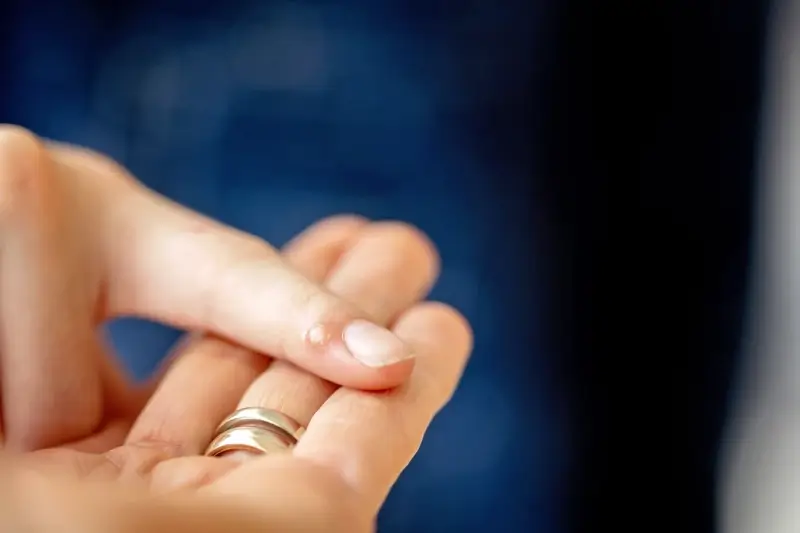 Co powoduje kurzajki?