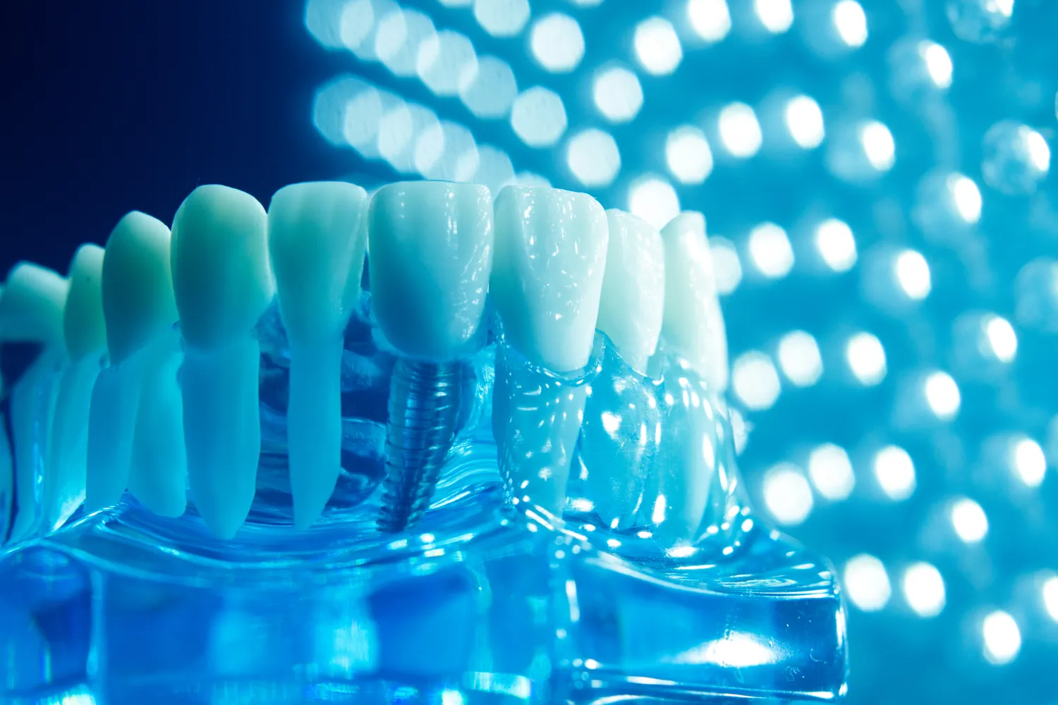 Ile kosztuje implanty zębów?