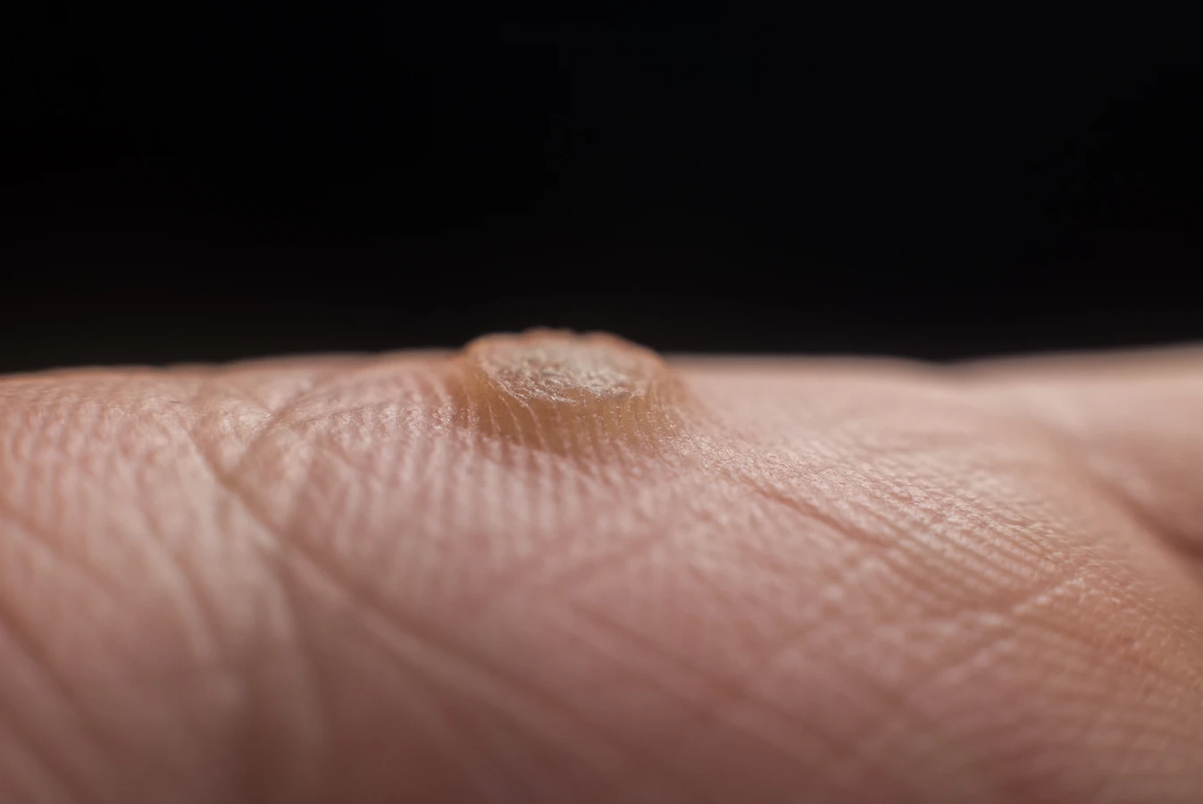 Glistnik jaskółcze ziele na kurzajki jak stosować?